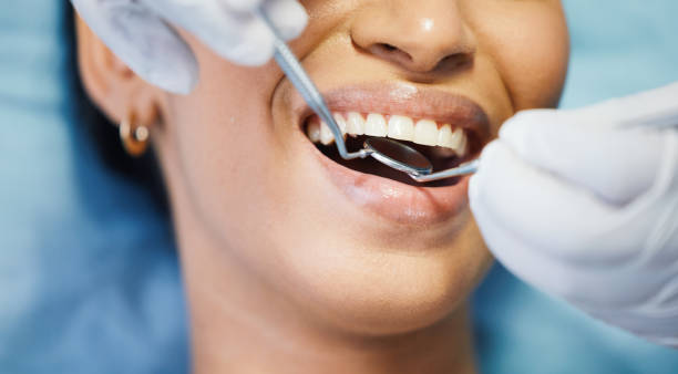 Best Emergency Dental Care for Broken or Chipped Teeth in Poughkeepsie, NY